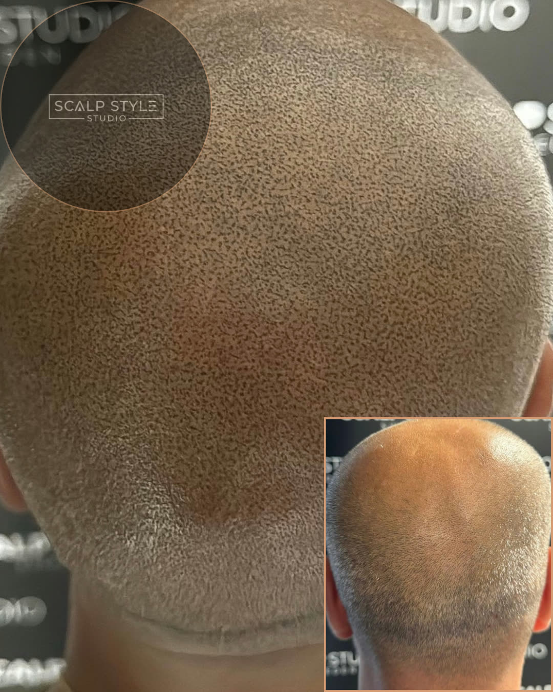 Før og efter scalp micropigmentation – ardækning og tættere hårpragt